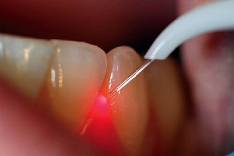 Лечение зубов и десен лазером